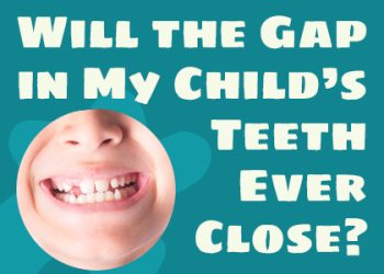 Lexington dentist Dr. Kevin Brewer of Brewer Family Dental talks about potential causes and treatments for gapped teeth in children.