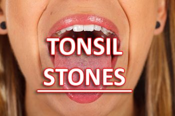 Lexington dentist, Dr. Brewer at Brewer Family Dental, tells patients about what causes tonsil stones and how to treat and prevent them from forming.