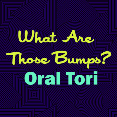 Lexington dentist, Dr. Kevin Brewer at Brewer Family Dental explains oral tori—what they are, why they happen, and whether they are a cause for concern.